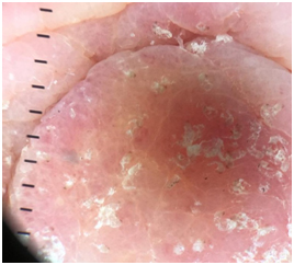 Eruzione eritematosa generalizzata in paziente immunodepressa: scabbia  norvegese – Scuola Dermatologica Chimenti