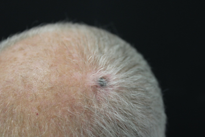 Lentigo maligna melanoma del cuoio capelluto con metastasi in transit